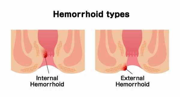 What to do about bleeding from internal incision scars?