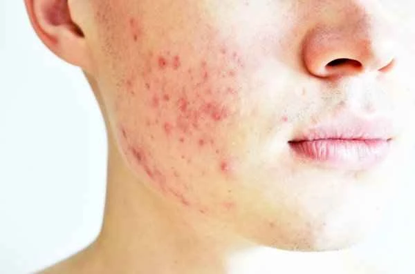 How to distinguish between acne scars and pimple marks?