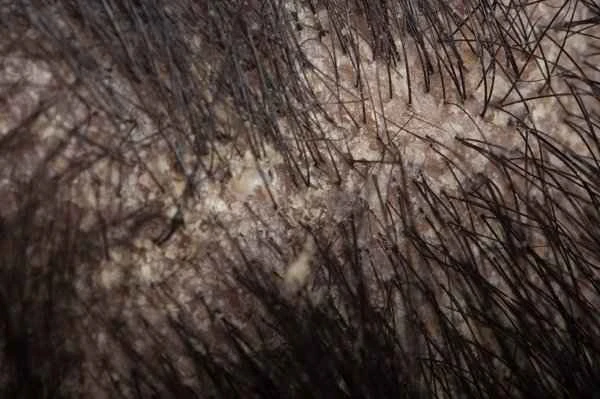 What happens if you shave your scalp for dandruff over a long period of time?