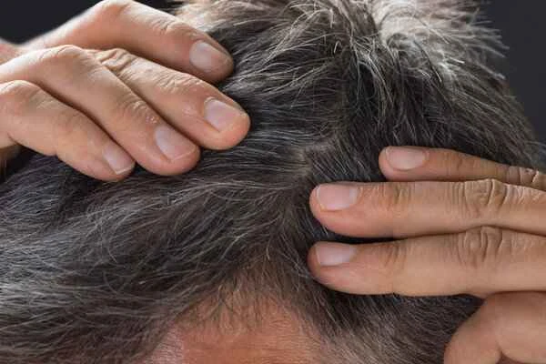 Is gray hair caused by folic acid deficiency?