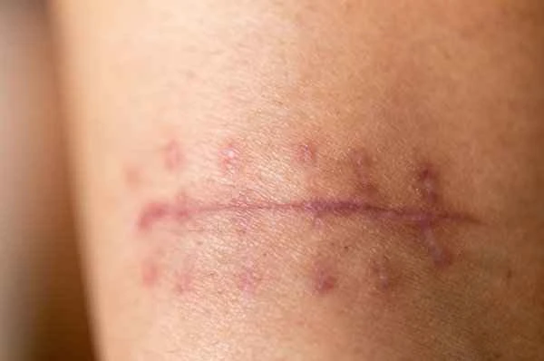 What to do about itchy and painful scars?