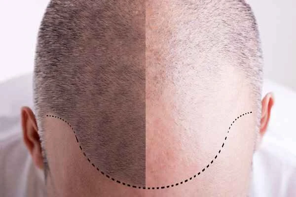 How to diagnose male pattern baldness