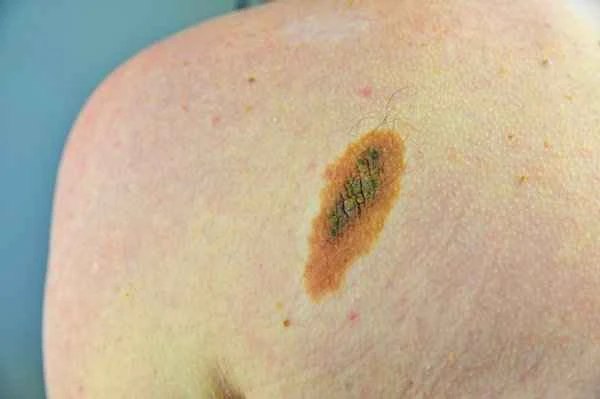 How long does the hyperplasia period of a mole removal scar last?