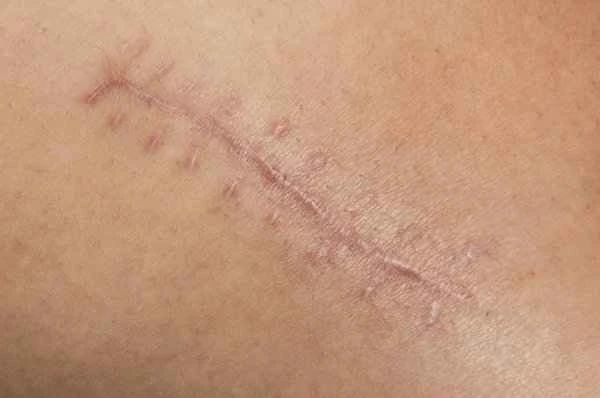 How to treat newly formed scars