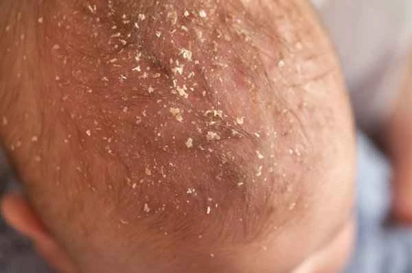 What causes pustules on the scalp?
