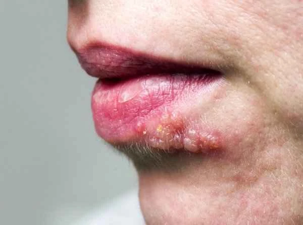How to treat cheilitis and facial allergies?