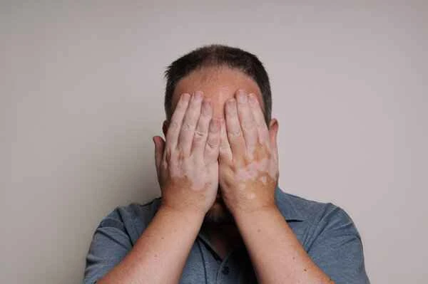 Can people with vitiligo eat pickled vegetables?