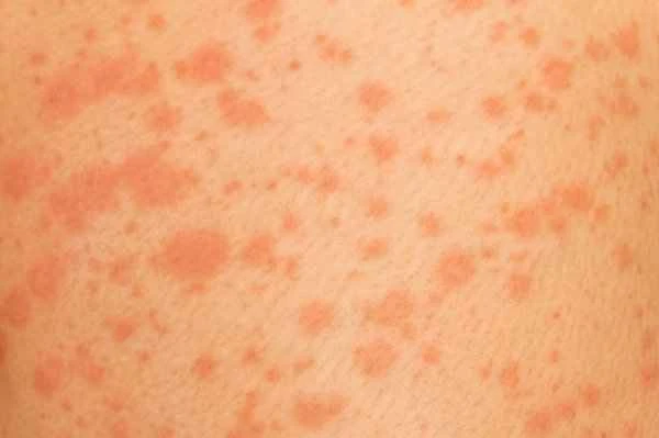 Is hives contagious in spring?