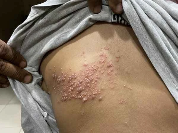How to treat shingles combined with insomnia?