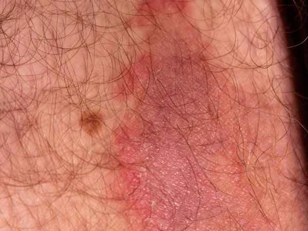 Itching and tinea of ​​the scrotum and groin in men