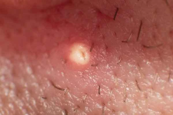What causes pustules on the scalp?