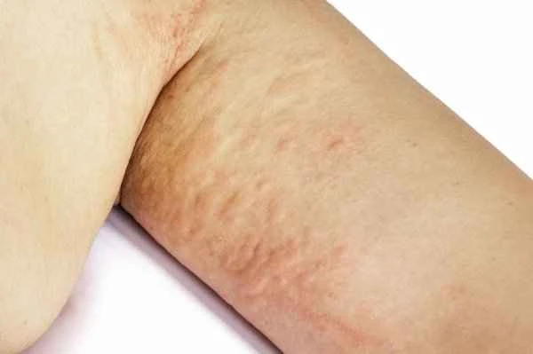 Can you die from chronic urticaria?