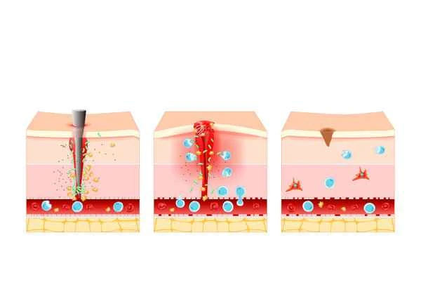 How to reduce the occurrence of hypertrophic scars?