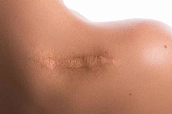 How to treat hypertrophic scars after surgery